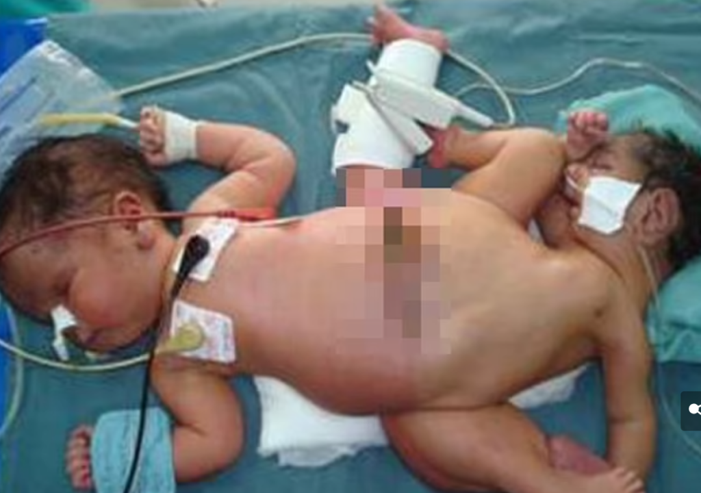 Daily Mail: в Индонезии провели операцию сиамским близнецам с тремя ногами